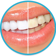 Teeth Whitening